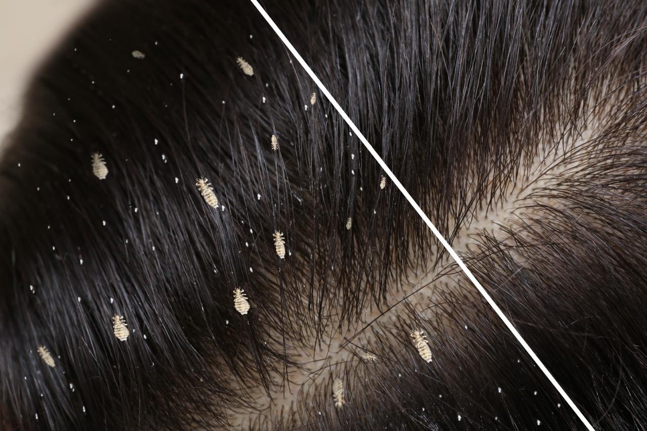 Lice Emergency: Why Waiting Makes It Worse