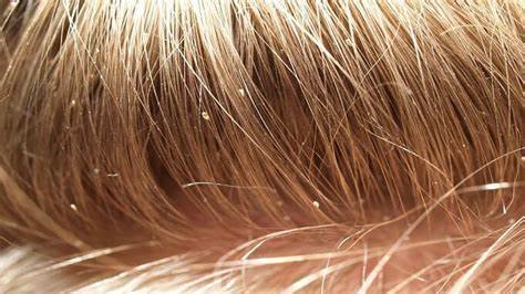School Lice Policy in Dubai | What Parents Should Know ?