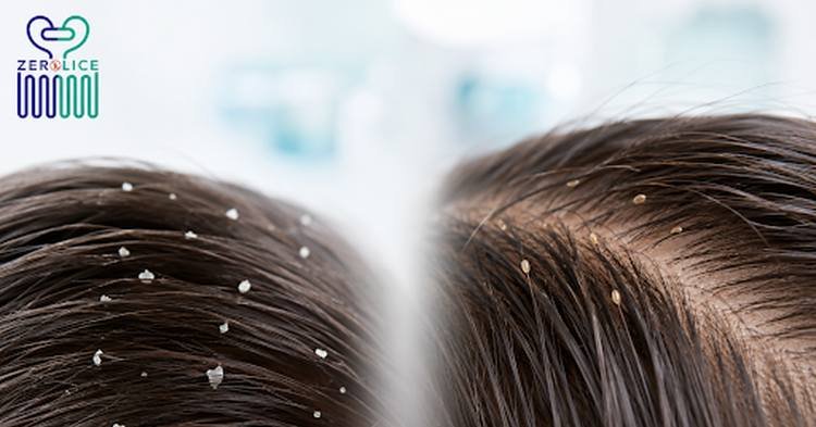 The Difference Between Lice and Dandruff How to Identify the Problem